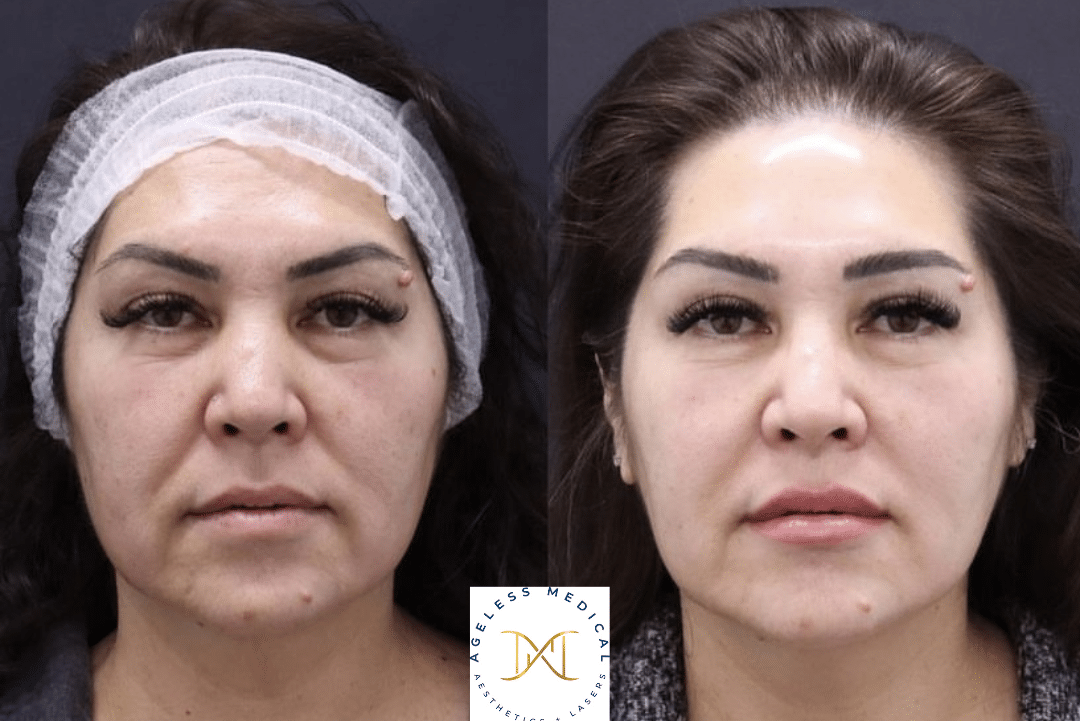 Clearlift Treatment Before and After | AgeLess Medical Aesthetics in Cheyenne, WY