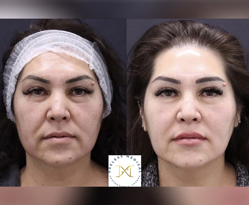 Clearlift Treatment Before and After Photos | AgeLess Medical Aesthetics in Cheyenne, WY