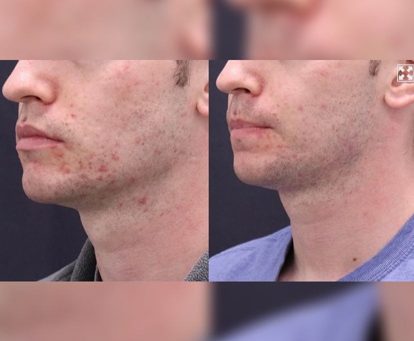 Microneedling is best for acne scars | Radiofrequency microneedling Treatment Before and After Photos | AgeLess Medical Aesthetics in Cheyenne, WY
