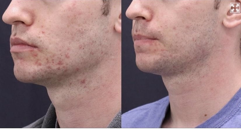 Microneedleacne Before and After Benefits | AgeLess Medical Aesthetics in Cheyenne, WY