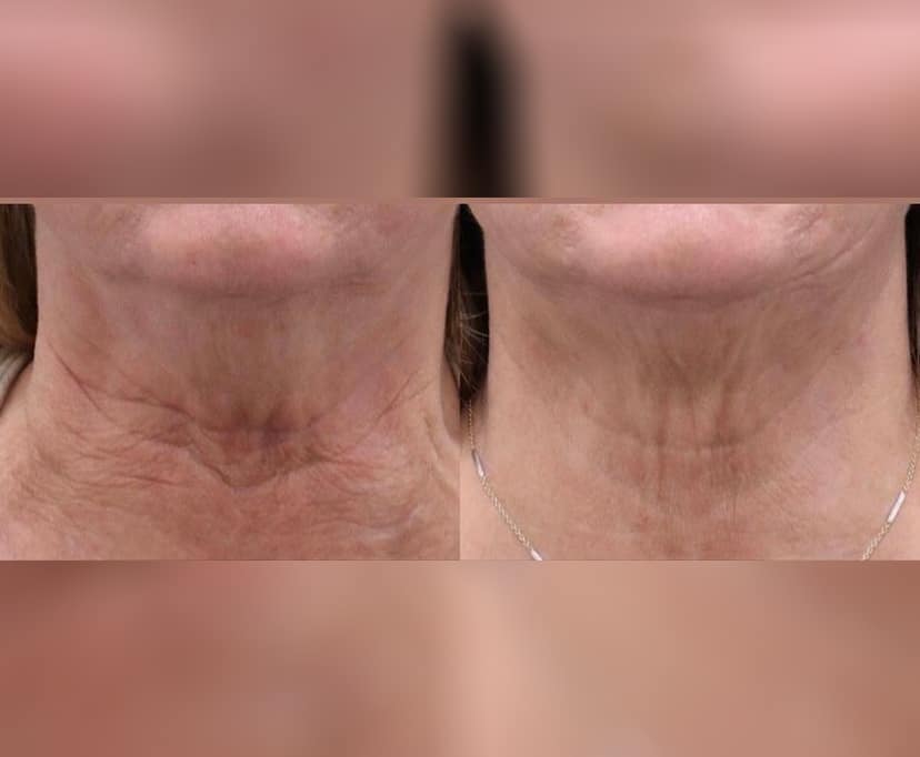 Platysmabotox Treatment Before and After Photos | AgeLess Medical Aesthetics in Cheyenne, WY