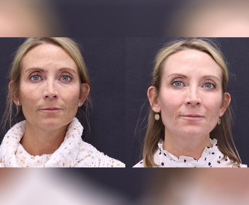 Revepeel Treatment Before and After Photos | AgeLess Medical Aesthetics in Cheyenne, WY