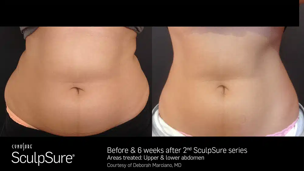 SculpSure Before and After Benefits | AgeLess Medical Aesthetics in Cheyenne, WY