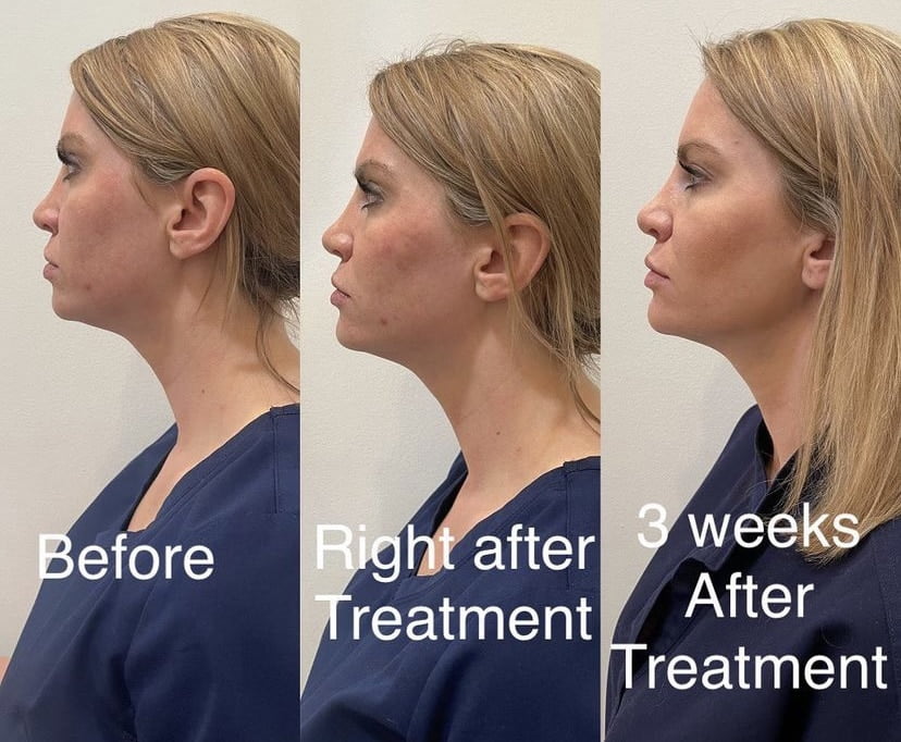 Women Acne Facial Treatment Before, After and 3 weeks After Photos | AgeLess Medical Aesthetics in Cheyenne, WY