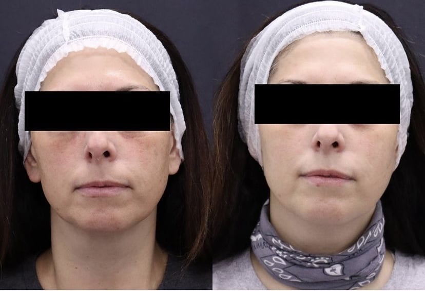 Dyevlafter Treatment Before and After Photos | AgeLess Medical Aesthetics in Cheyenne, WY