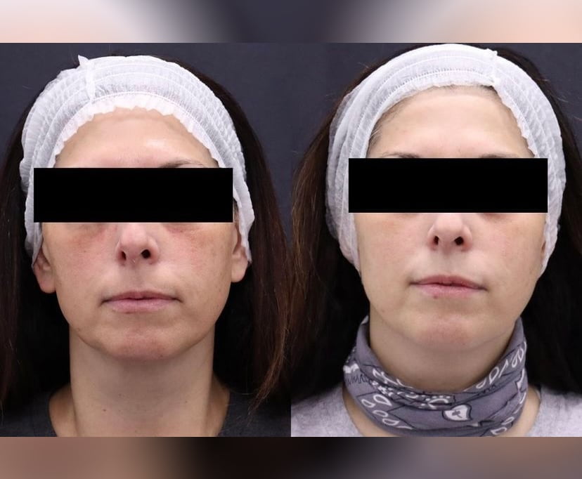 Dye-VL Laser Treatment Before and After Photos | AgeLess Medical Aesthetics in Cheyenne, WY