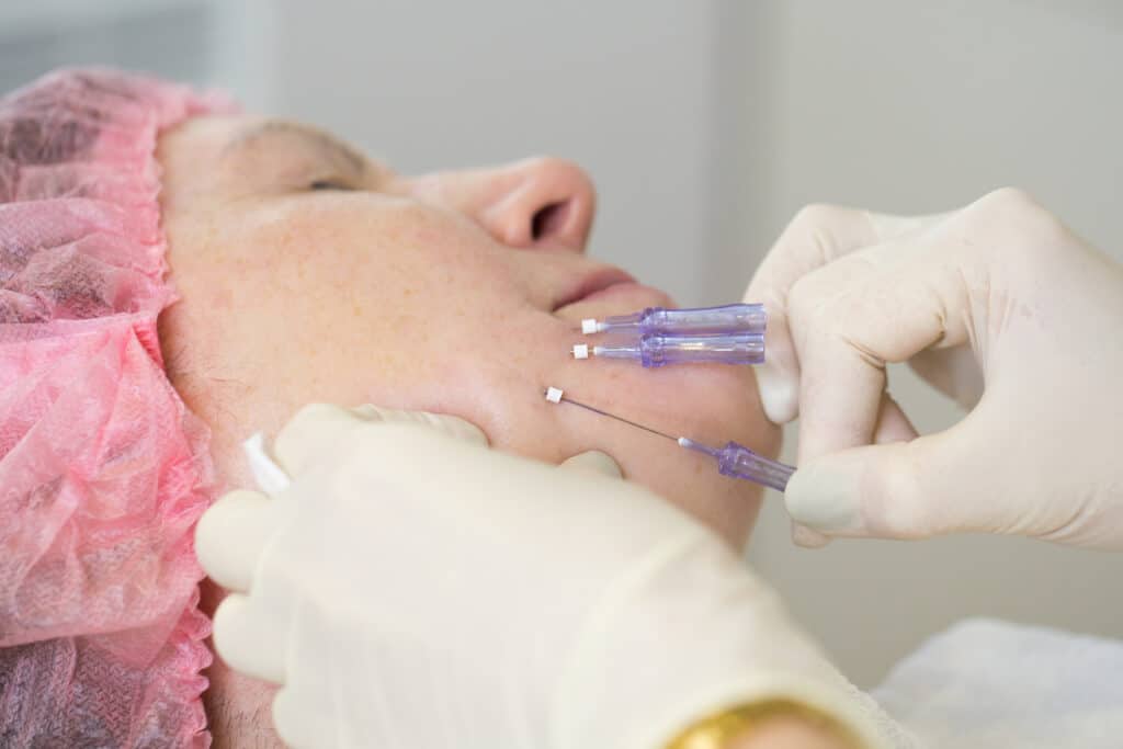 PDO Threads: Non-Surgical Youthful Skin Solution