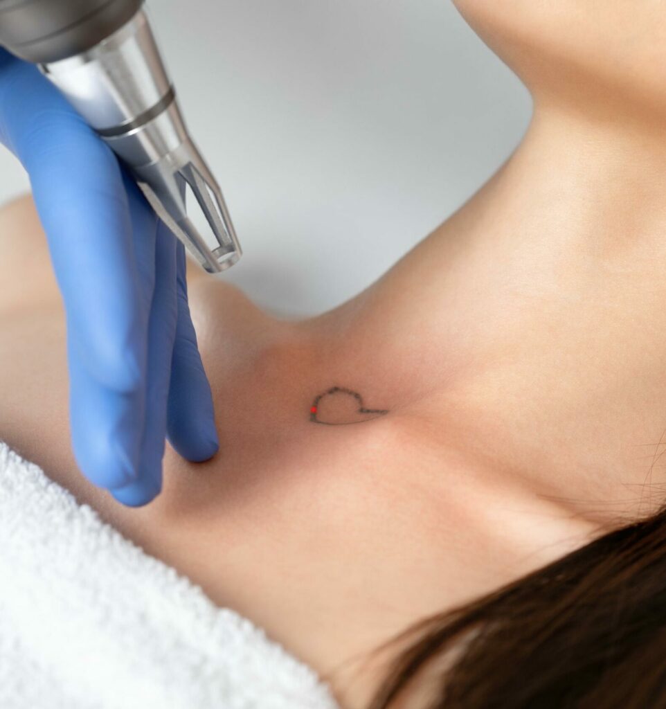 Laser tattoo removal procedure on a young woman in the Cheyenne, WY, clinic.