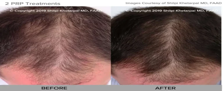 a collage of hair loss