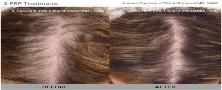 a collage of hair loss