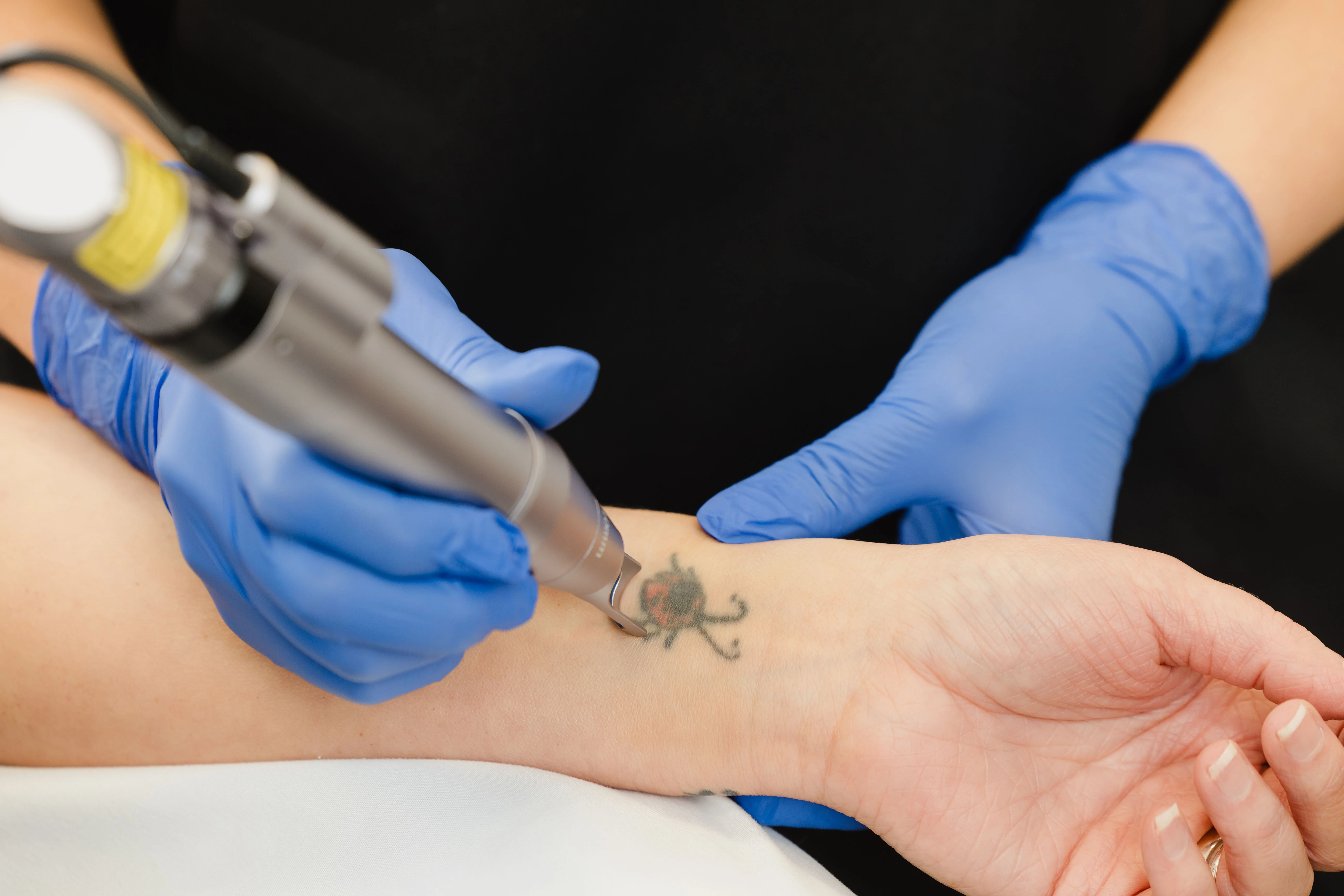 Laser Tattoo Removal in Cheyenne, WY