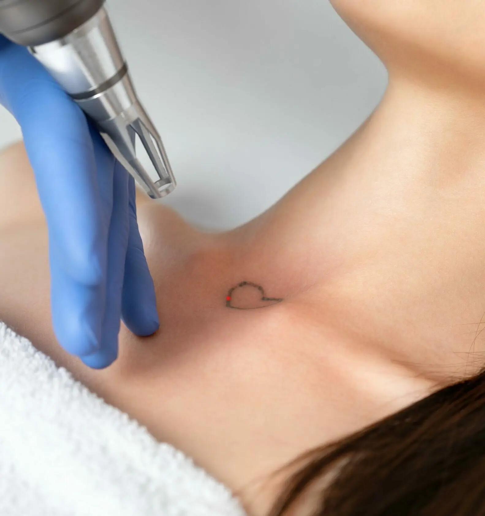 Laser tattoo removal procedure on a young woman in the Cheyenne, WY, clinic.