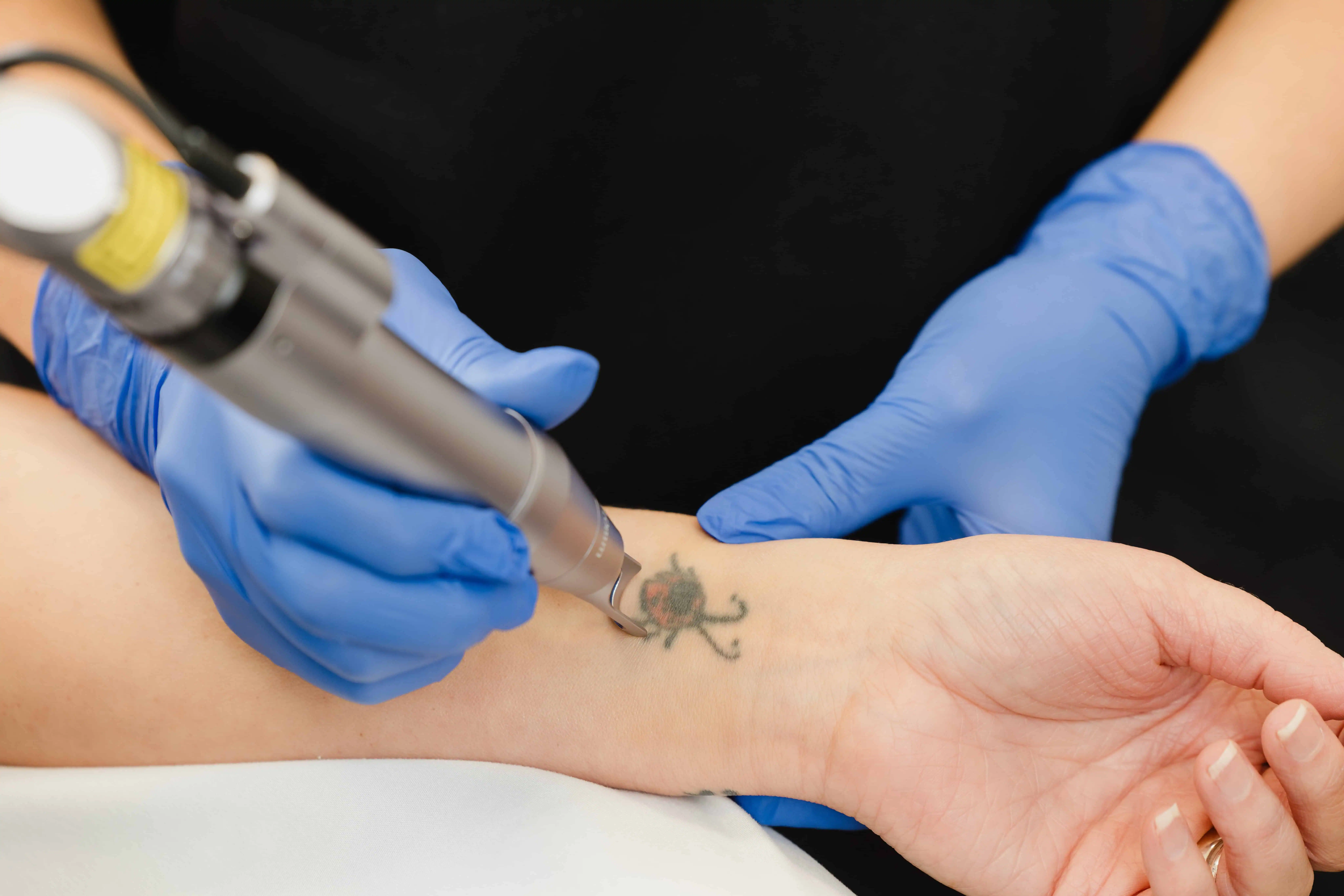 A woman gets Laser Tattoo Removal in Cheyenne, WY
